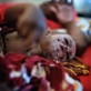 A baby who is suffering from intense burns after seeing a traditional healer. Kate Holt.